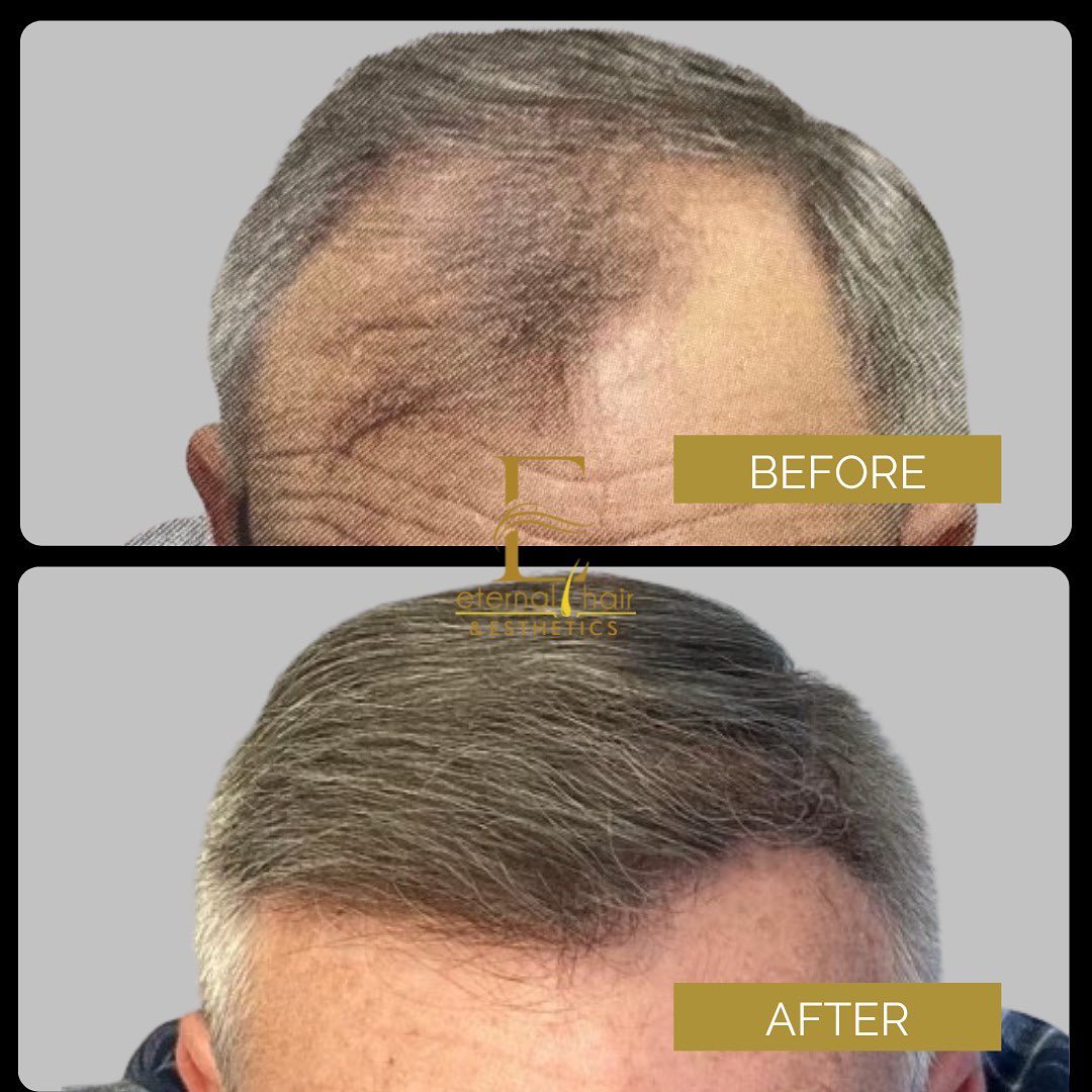 Male hair transplant in NJ