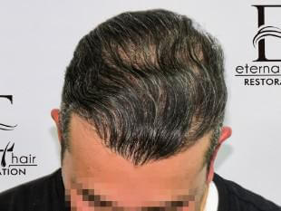 FUE Crown Hair Transplant NJ
